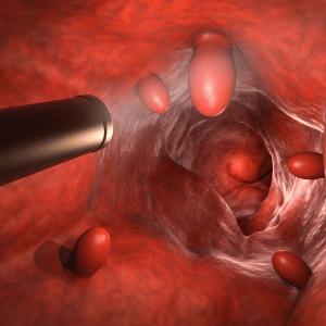 Cancer Prevention